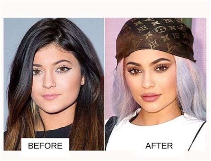 Kylie Jenner Plastic Surgery: A Comprehensive Look at Her Transformations