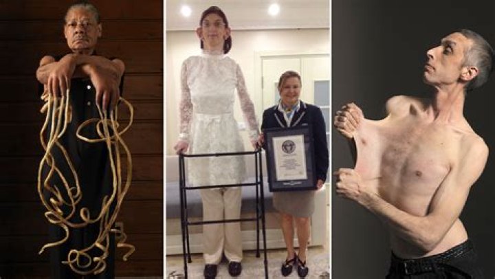 Skinniest Person Alive: Understanding the Phenomenon and Its Implications