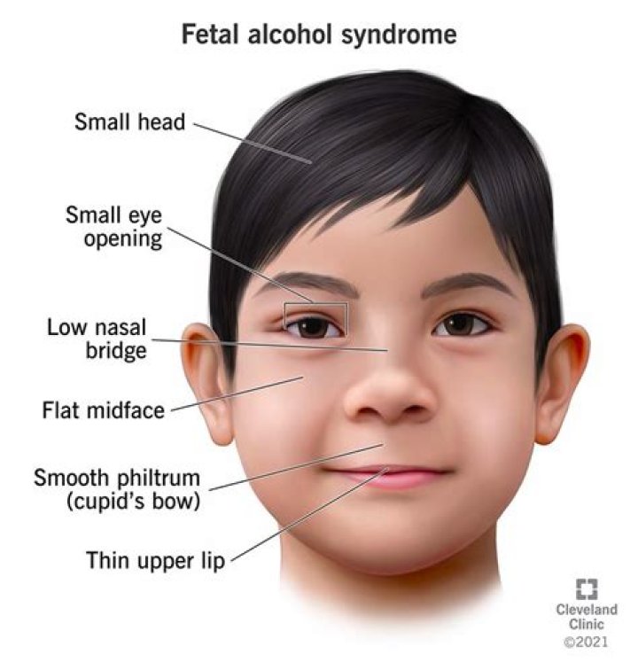 Understanding Edward Bluemel Syndrome: A Unique Genetic Condition