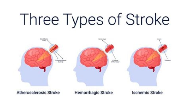 Unraveling the Mystery of the Pioneer Woman: Stroke Cause of Death